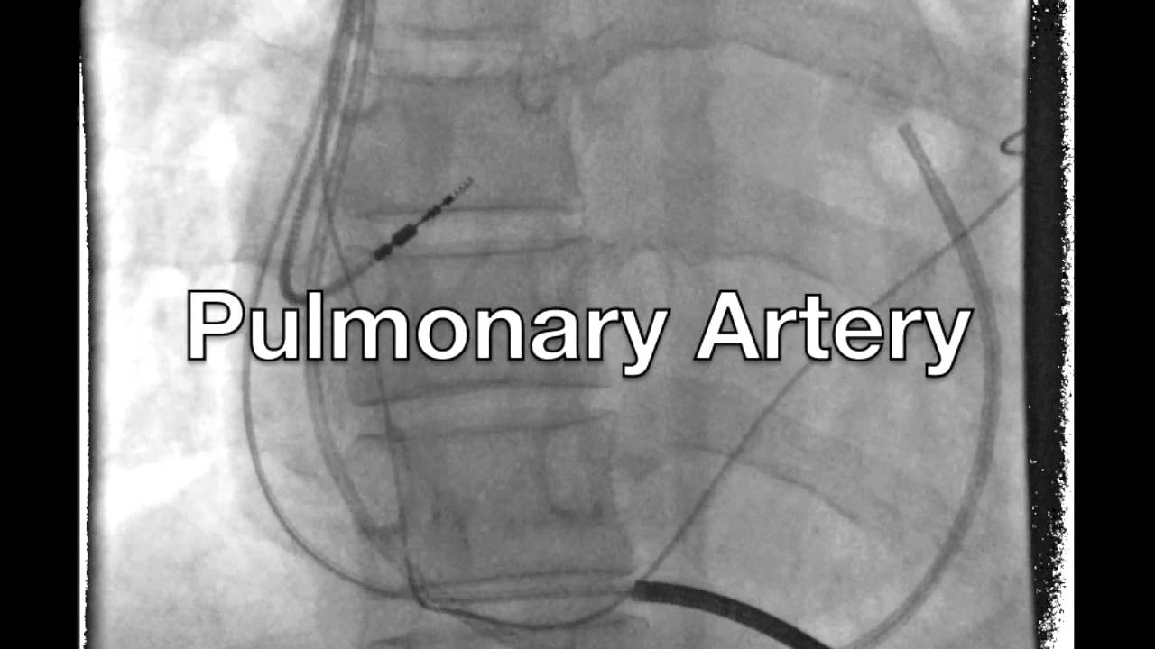 Right Heart Catheterization - Pressures