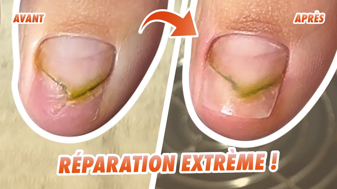 RÉPARATION EXTRÊME 💅🏼 COMMENT RÉPARER un ONGLE COMPLÉMENT ARRACHÉ ? 😱