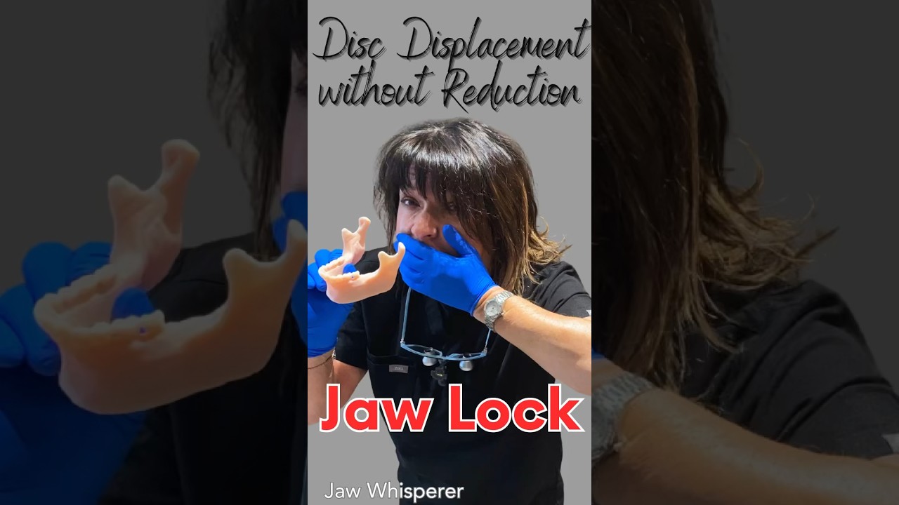 Disc Displacement Without Reduction Causing Jaw Lock #tmd #jawpain