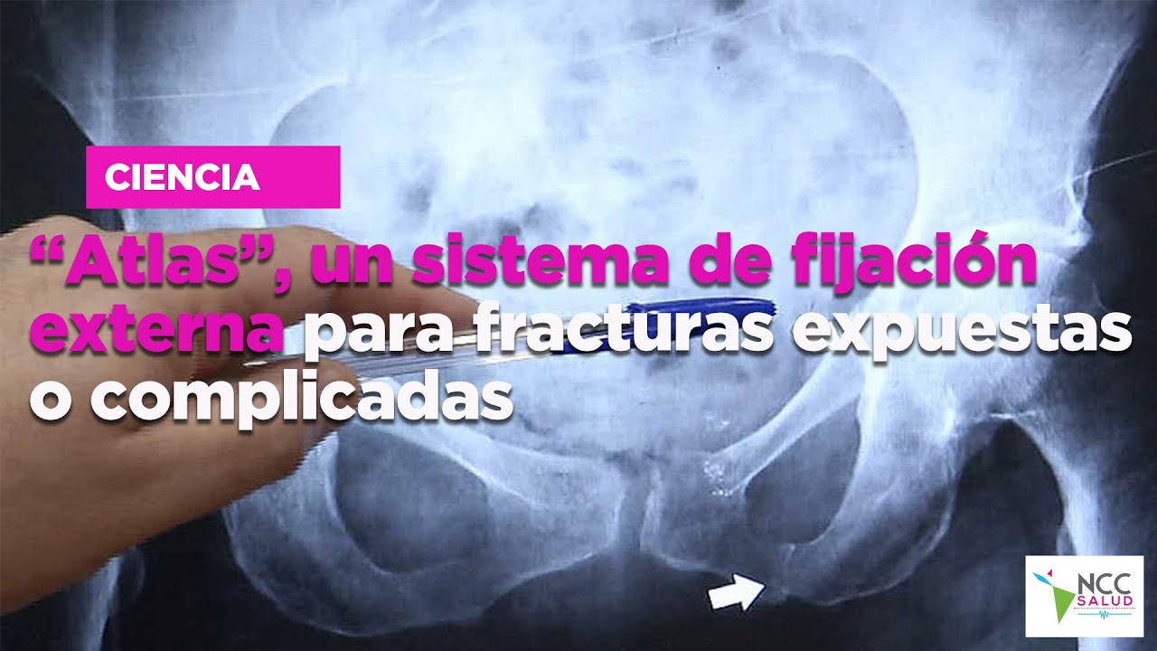 &ldquo;Atlas&rdquo;, un sistema de fijaci&oacute;n externa para fracturas expuestas o complicadas