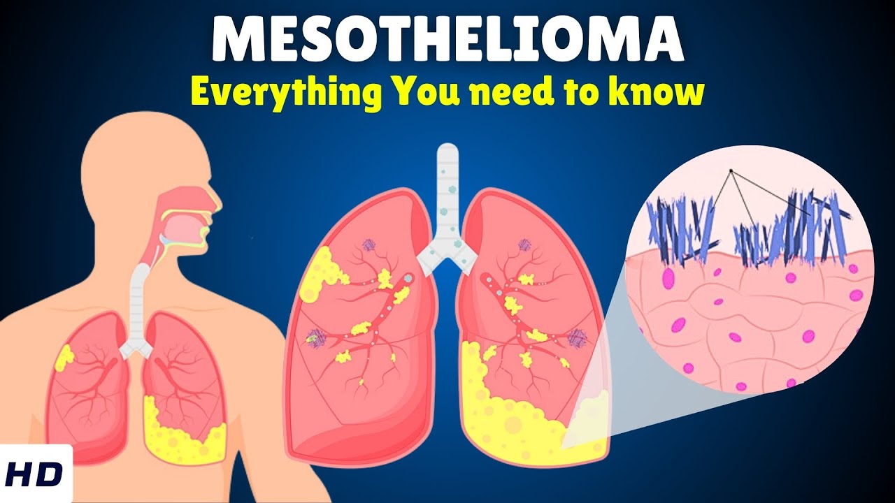 Mesothelioma &ndash; Causes, Signs and Symptoms, Diagnosis & Treatment