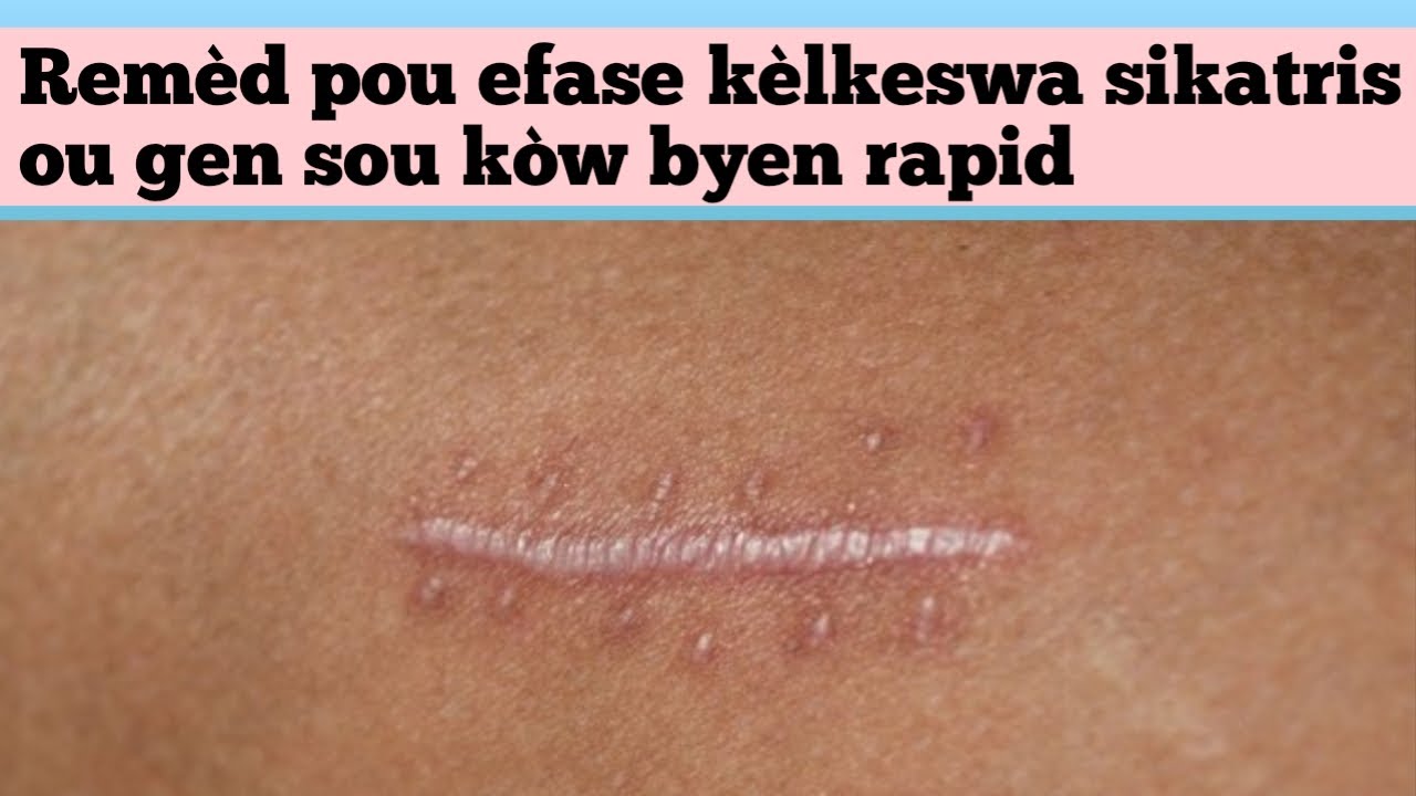 Remèd natirèl pou efase kèlkeswa sikatris ou gen sou kòw byen rapid