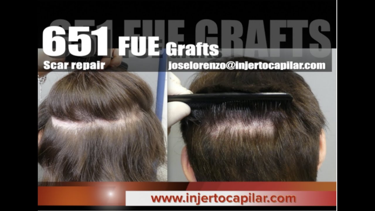 651FUE Grafts. Scar repair without shaving. 10 months update. Injertocapilar.com.2610/2021