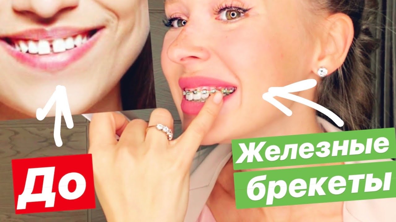 9 ВАЖНЫХ ВОПРОСОВ про БРЕКЕТЫ | СТАВЛЮ ТРЕТИЙ РАЗ! почему не элайнеры? | какая ЦЕНА?