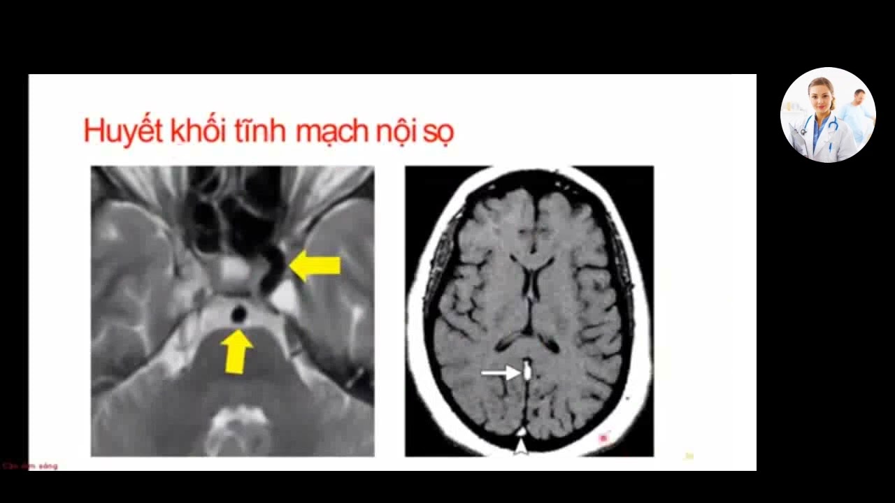 Các chuỗi xung MRI sọ não cơ bản | Ts. Bs. Phạm Thái Hưng