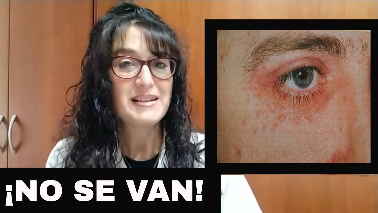 GRANITOS en los OJOS que NO SE VAN Dra. Gloria Abad Dermatóloga