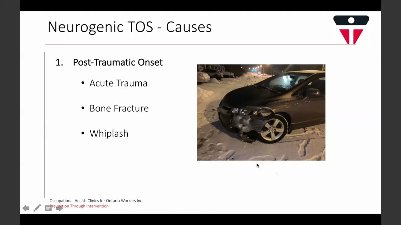 RSI Day 2022 Week 1 – Thoracic Outlet Syndrome