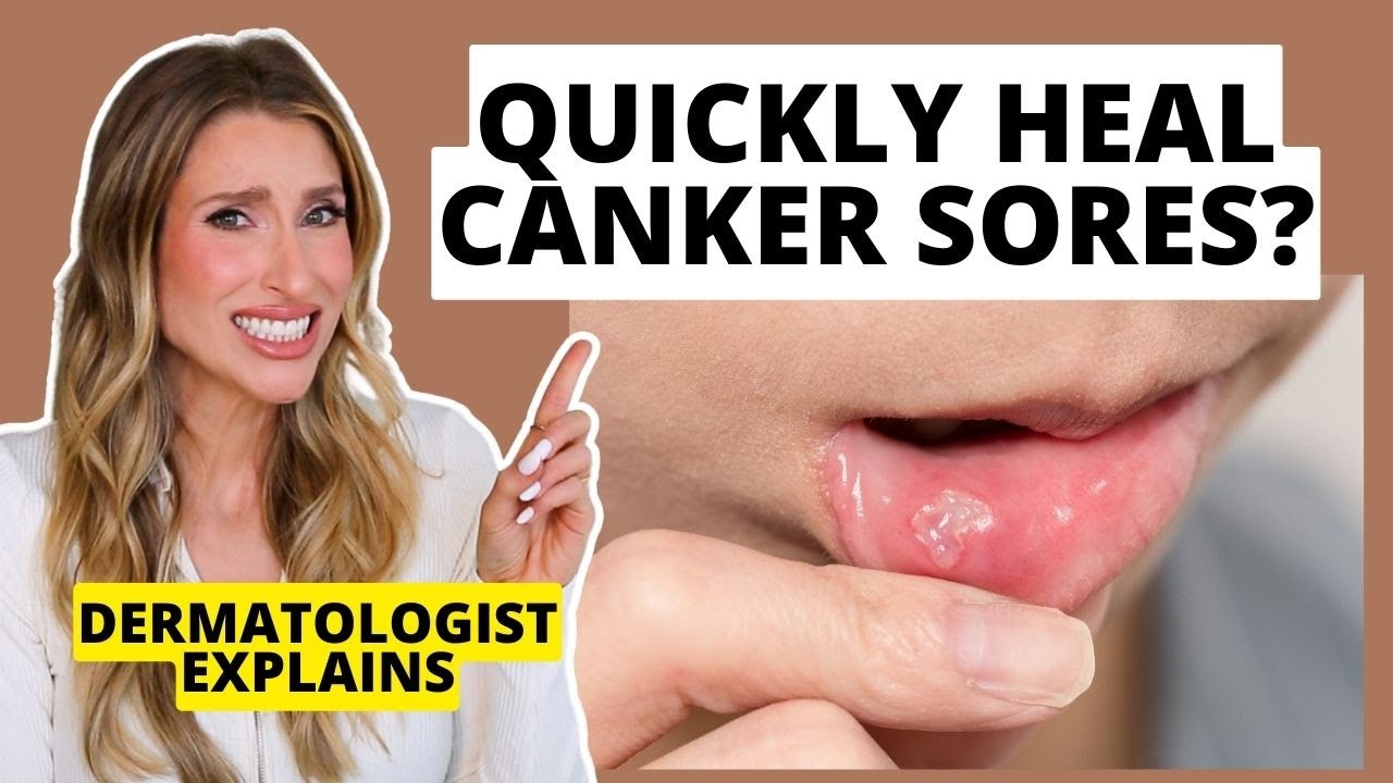 Szybkie gojenie się aft: Jak zapobiegać i leczyć je szybciej | Wyjaśnia dermatolog