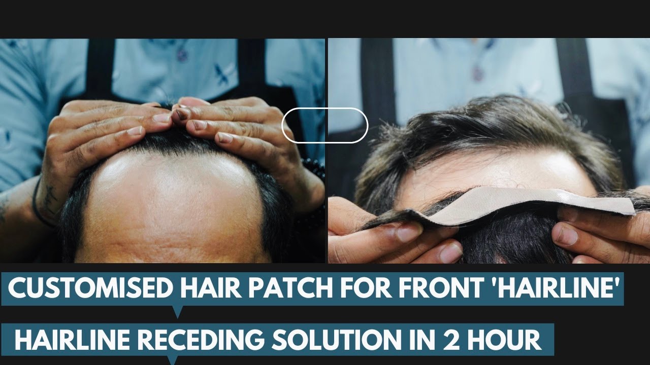 Hair Receding Solution | Customised Hair Patch For Front only @Hair wig house 9953384242 #Hairpatch
