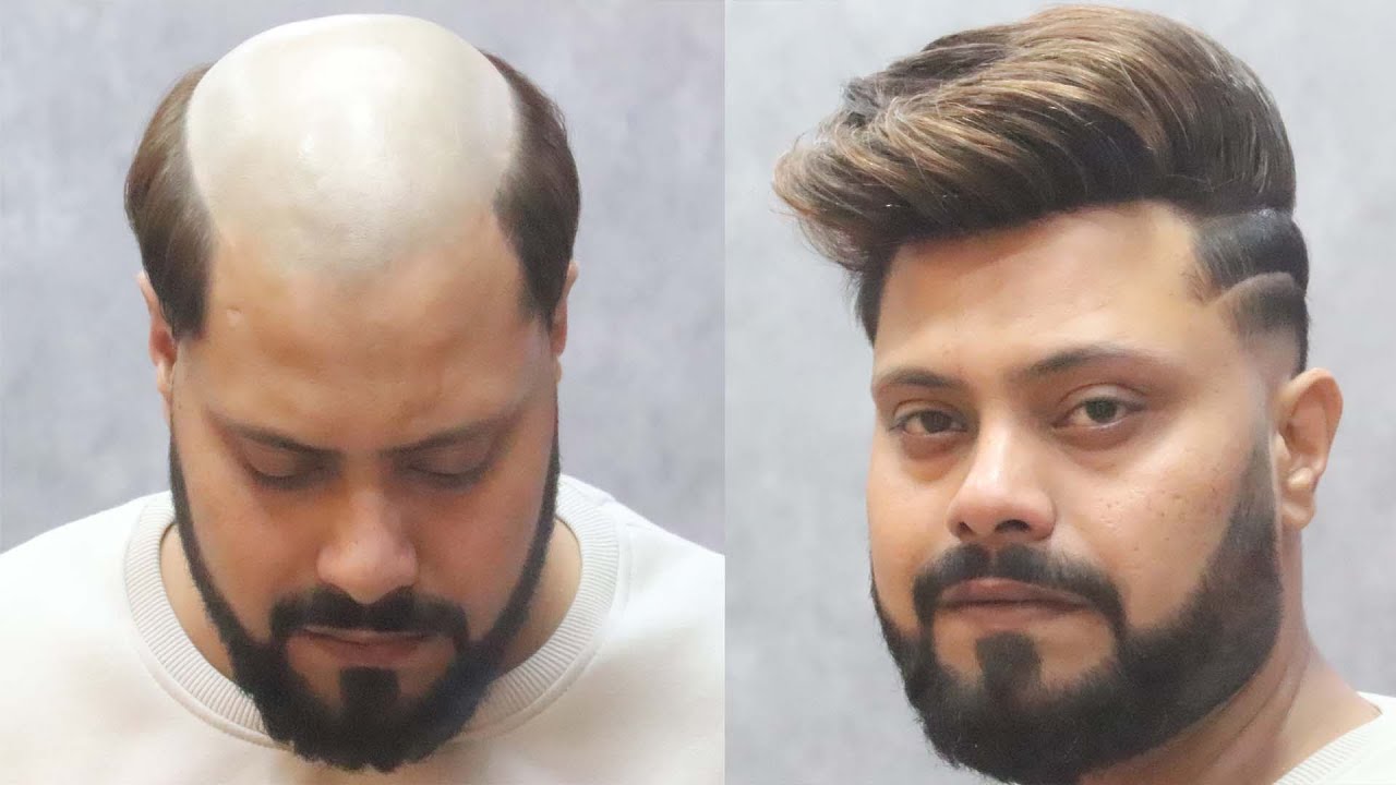 Undercut paffy hair style with hair patch | by  Abdul Rehman in delhi | Call Us - 9873152223