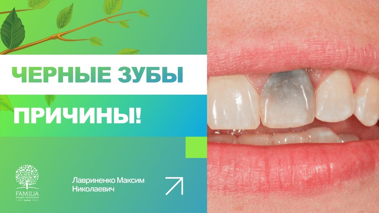 🤔 Почему появляются черные точки на зубах?