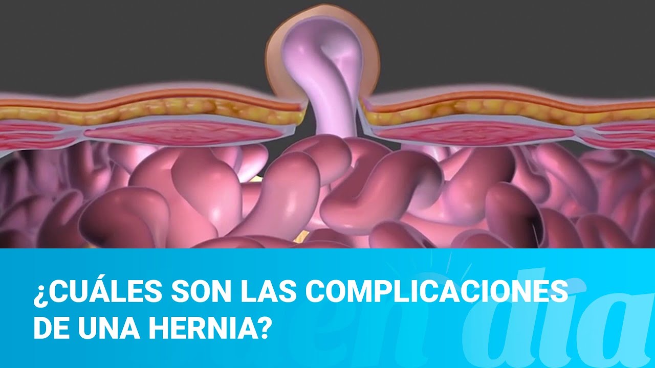¿Cuáles son las complicaciones de una hernia?