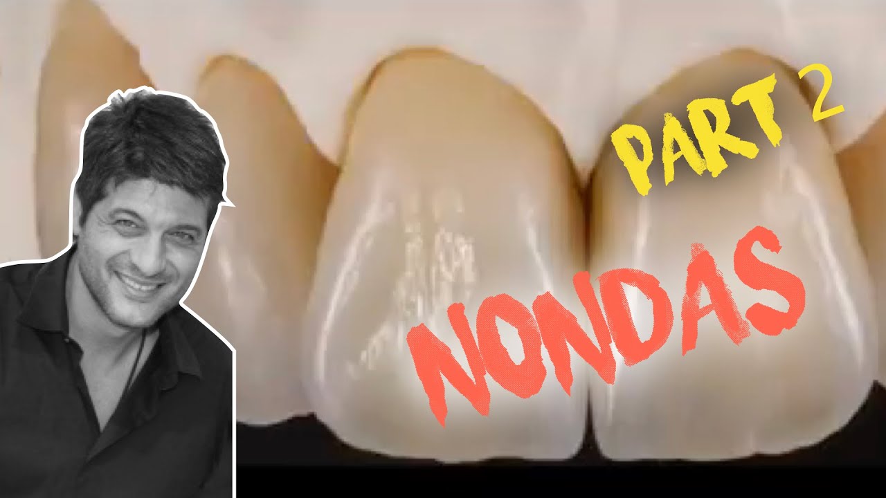 Anterior All -Ceramic Veneers PART 2. Don`t miss this awesome lecture by Master Nondas!