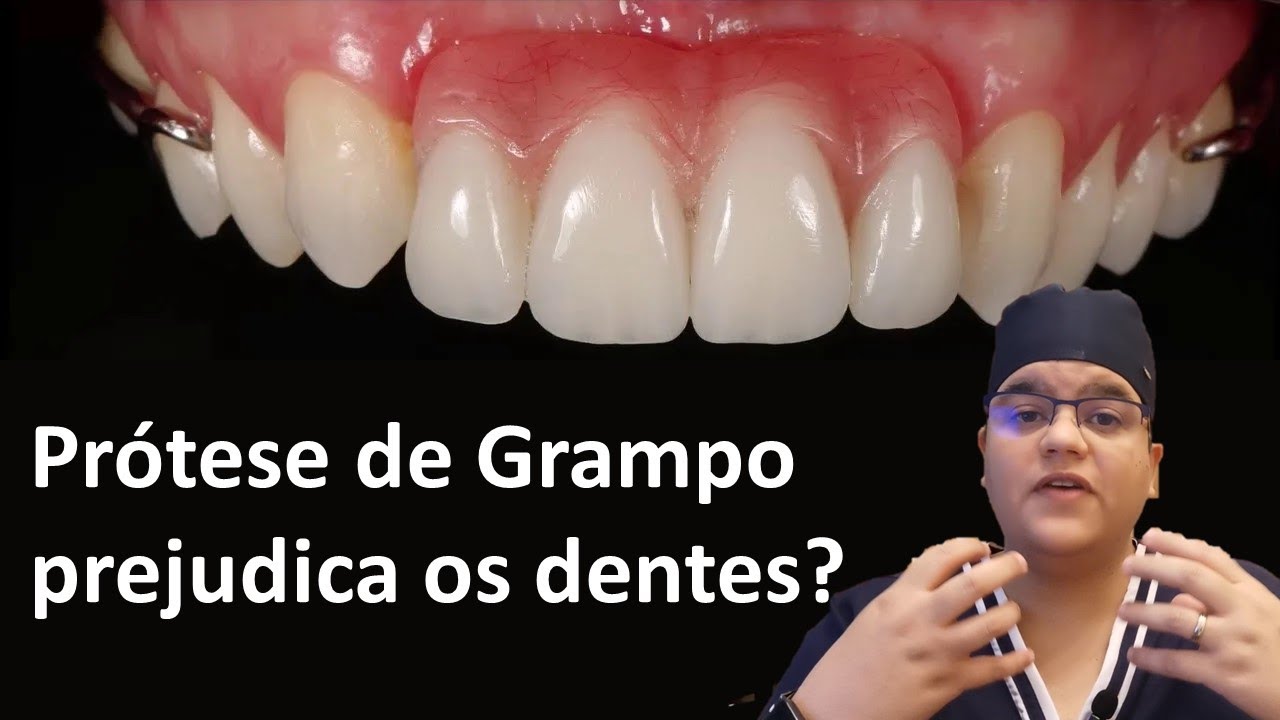 Prótese de grampo prejudica os dentes?| Dra Bianca Rosa | Clínica Bianca Rosa
