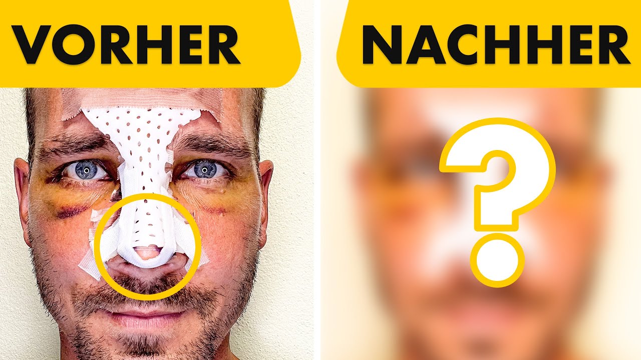 Nasen-OP - Er hat eine Woche lang jeden Tag ein Foto gemacht | Heilungsverlauf | Dr. Jungwirth