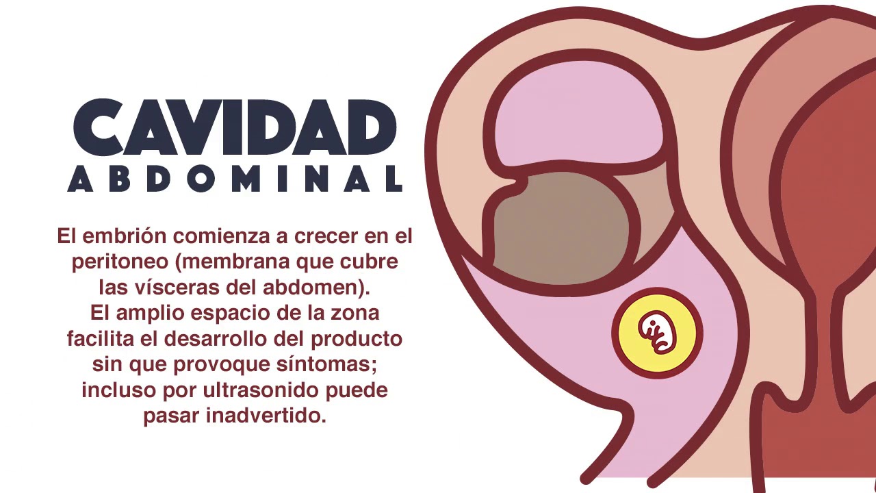 Embarazo ect&oacute;pico