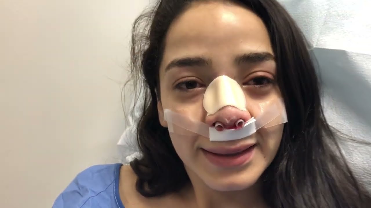 Kotler Nasal Airway is Amazing!