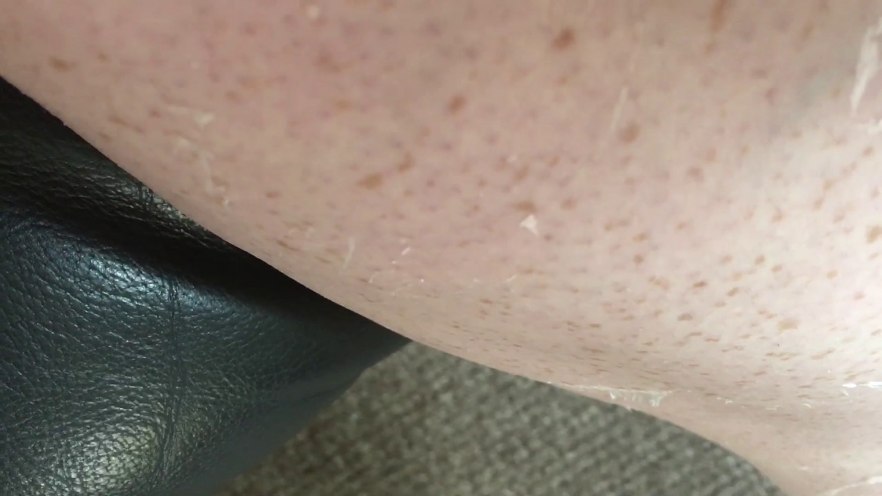 Peeling Sunburn Part 2
