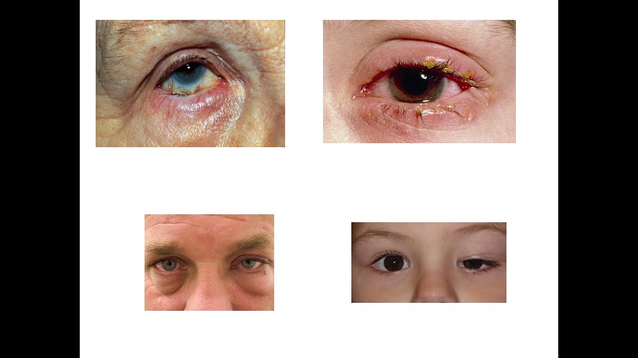 vidio eye assessment تقيم صحى الفرقة الاولى  الدبلوم التخصصى
