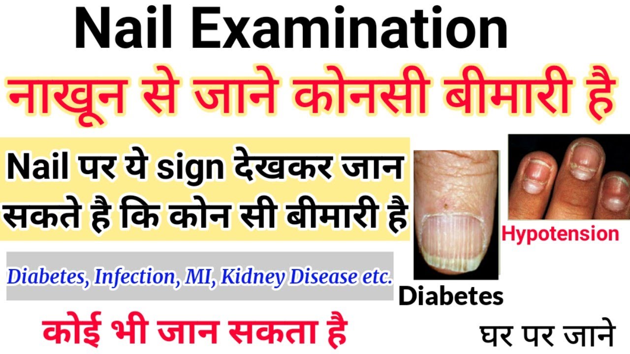 नाखून देखकर बीमारी का पता लगाए || Nail Examination || Disease sign on Nails