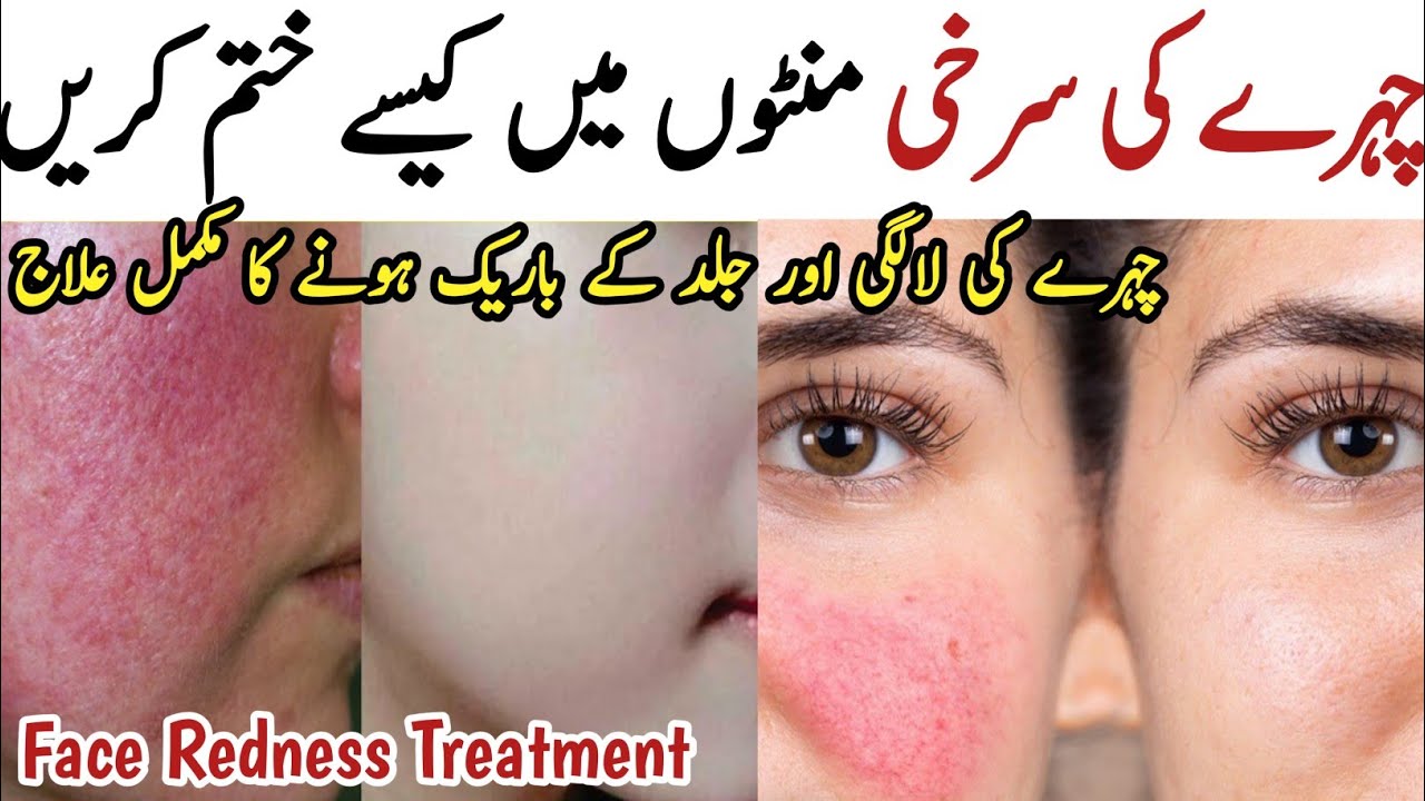 Face Redness Treatment at Home | Chehre Ki Redness Kesy khatam Kare | Damage Skin Repair