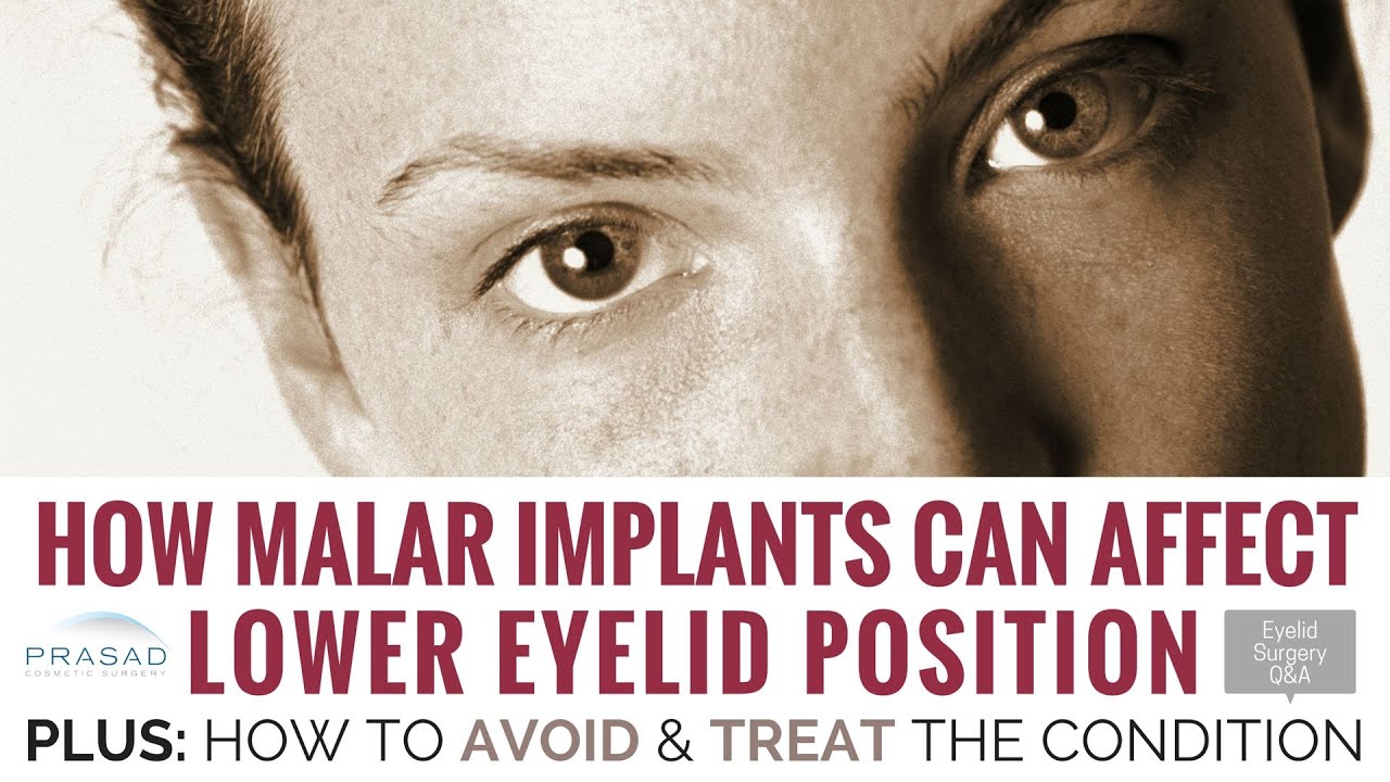How Eyelid Shape Can be Affected by Malar Implant Removal, and How to Avoid and Treat It