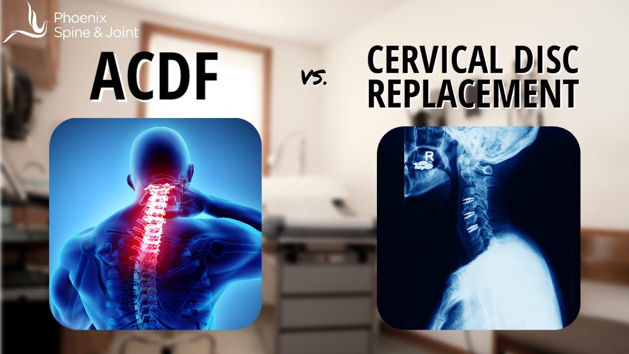 Neck fusion (ACDF)  vs.  artificial disc | A New Study