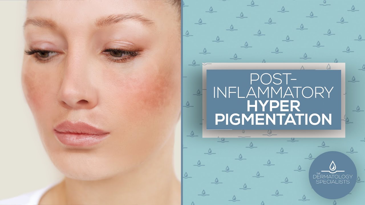 Post-Inflammatory Hyper Pigmentation