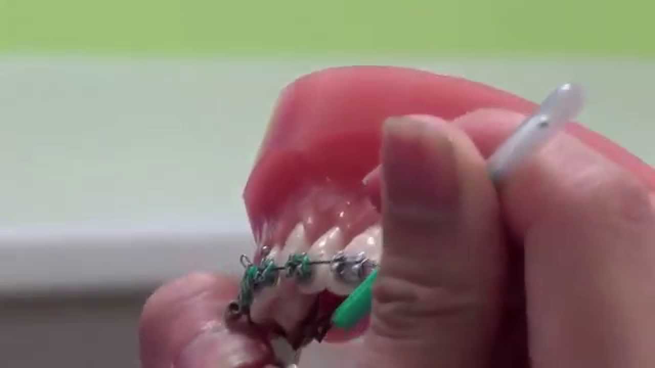 What to do when the rubber ties come off of your braces