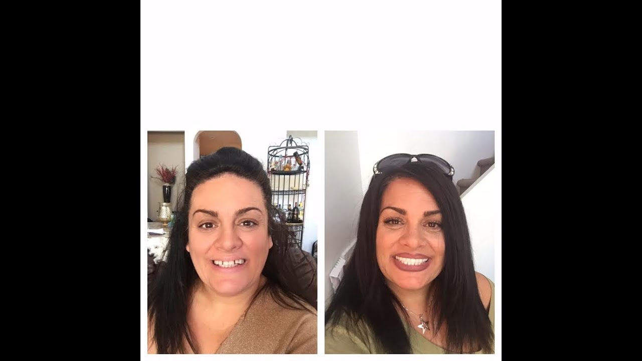 My Snap In Denture Journey in Mexico All My Teeth were EXTRACTED