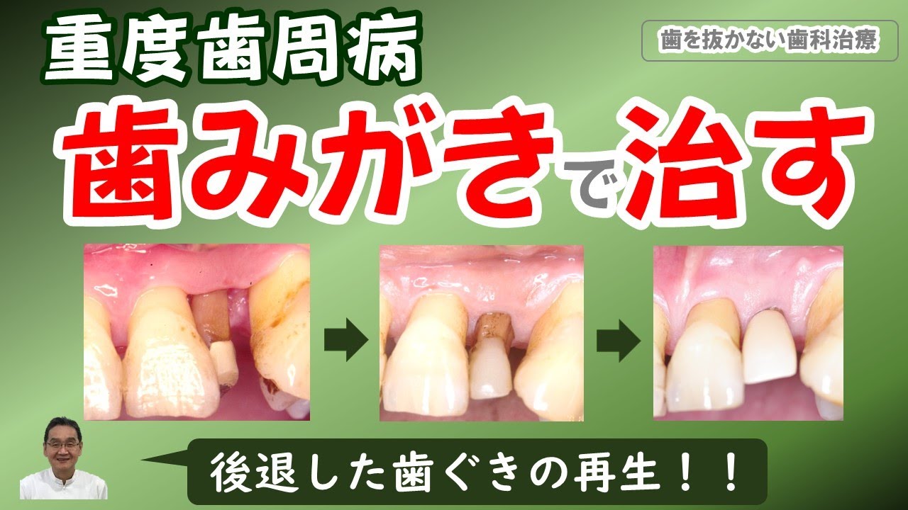 歯周病、歯みがきで治す：後退した歯ぐきがもとに戻る！！！