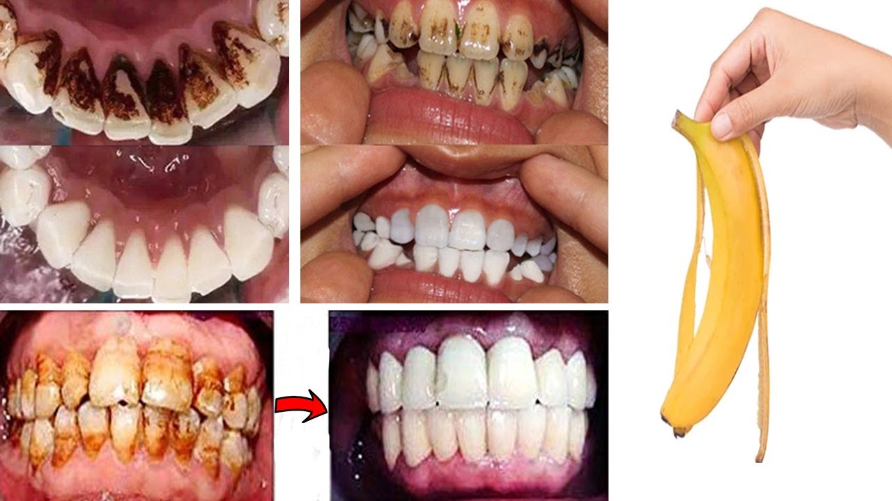 Уход за зубами шаг за шагом, чтобы зубы белели | Отбеливание зубов в домашних условиях