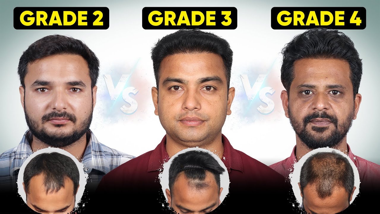 Hair Transplant in Chennai | Best Results & Cost of Hair Transplant in Chennai