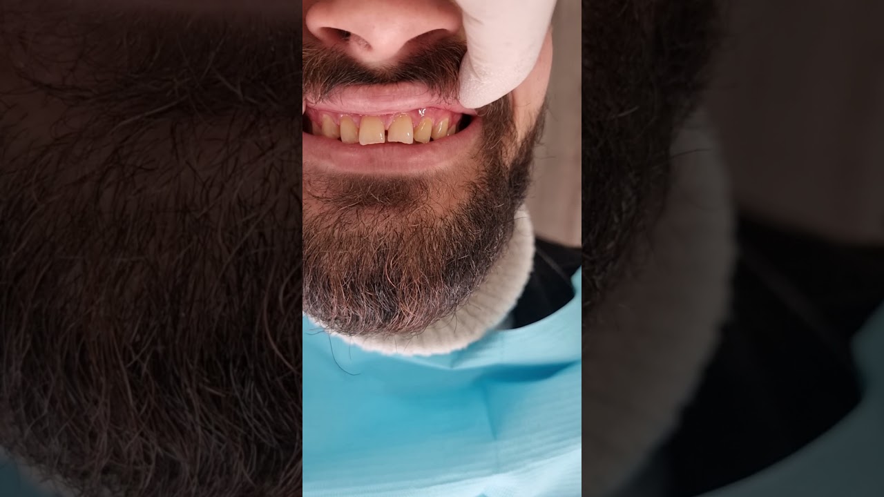احدث طريقة لعمل قشور الحشوات التجميلية (فيسينغ الأسنان) مع الدكتور عمر فوده
