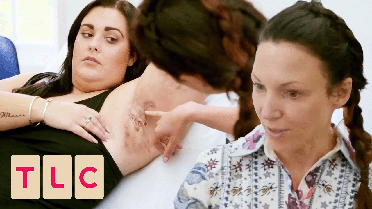 Dr. Emma Treats Woman with Chronic Abscesses That Could Burst Any Moment! | The Bad Skin Clinic