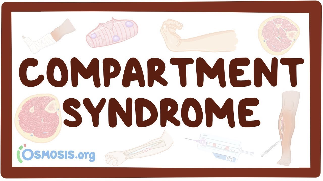 Compartment syndrome - an Osmosis Preview