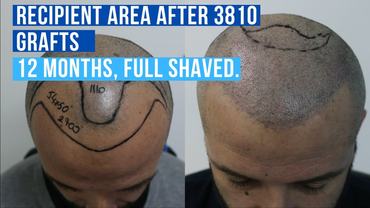 Hair Transplant Turkey 3810 Grafts: No DHI Hair Transplant (2020)