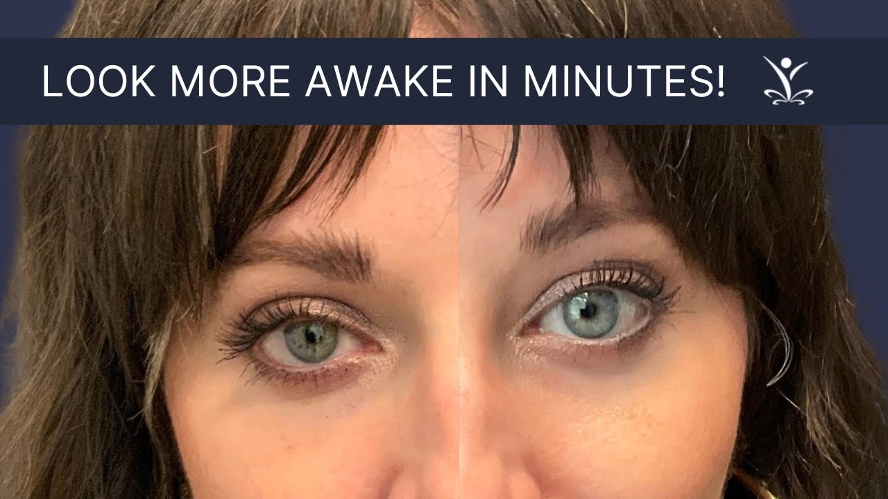 Get a Non-Surgical, Instant Eyelid Lift with Upneeq Eye Drops!