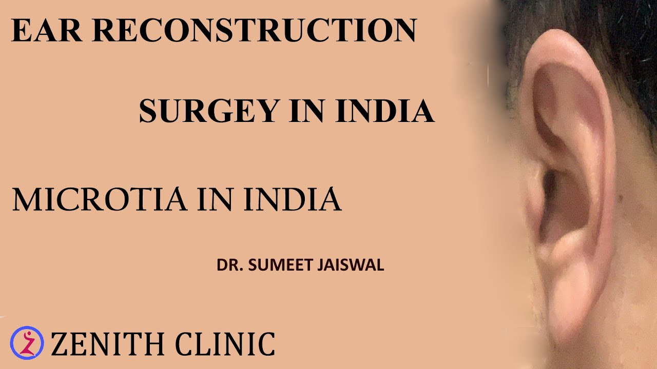 Ear reconstruction surgery in India | Microtia in India | Zenith Clinic |Dr Sumeet | Hindi | 2020