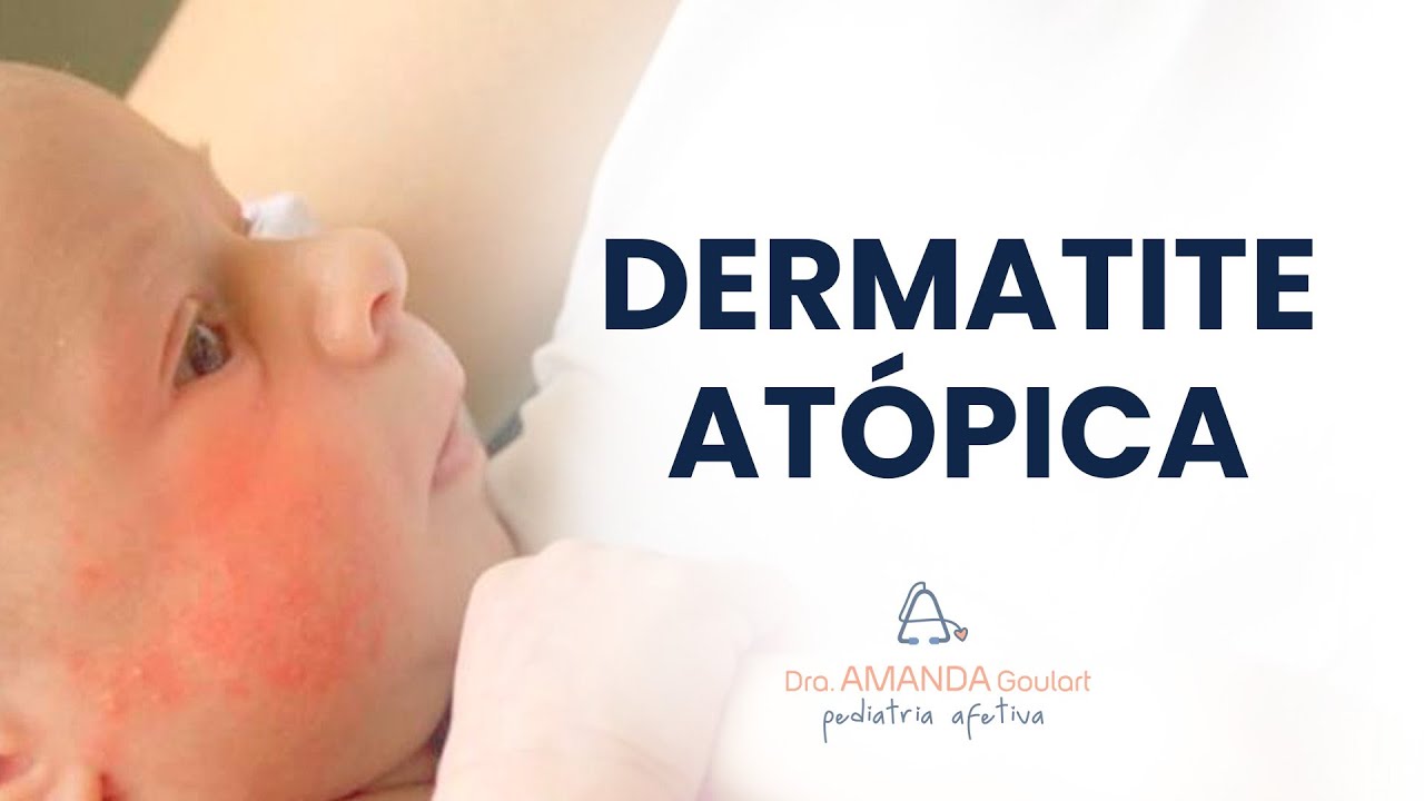 Dermatite Atópica em bebês: o que é, como identificar e como tratar!