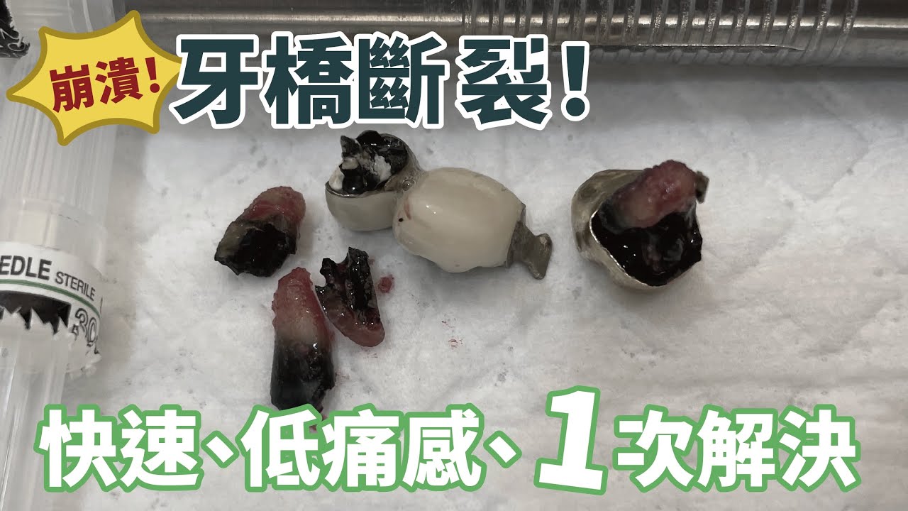 牙橋也會壞？😵‍💫治療6大重點一次完成–即拔即種、補骨粉、藍光導航輔助