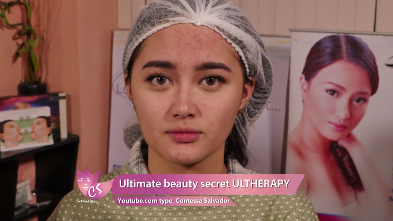 Ultherapy Ultimate beauty secret