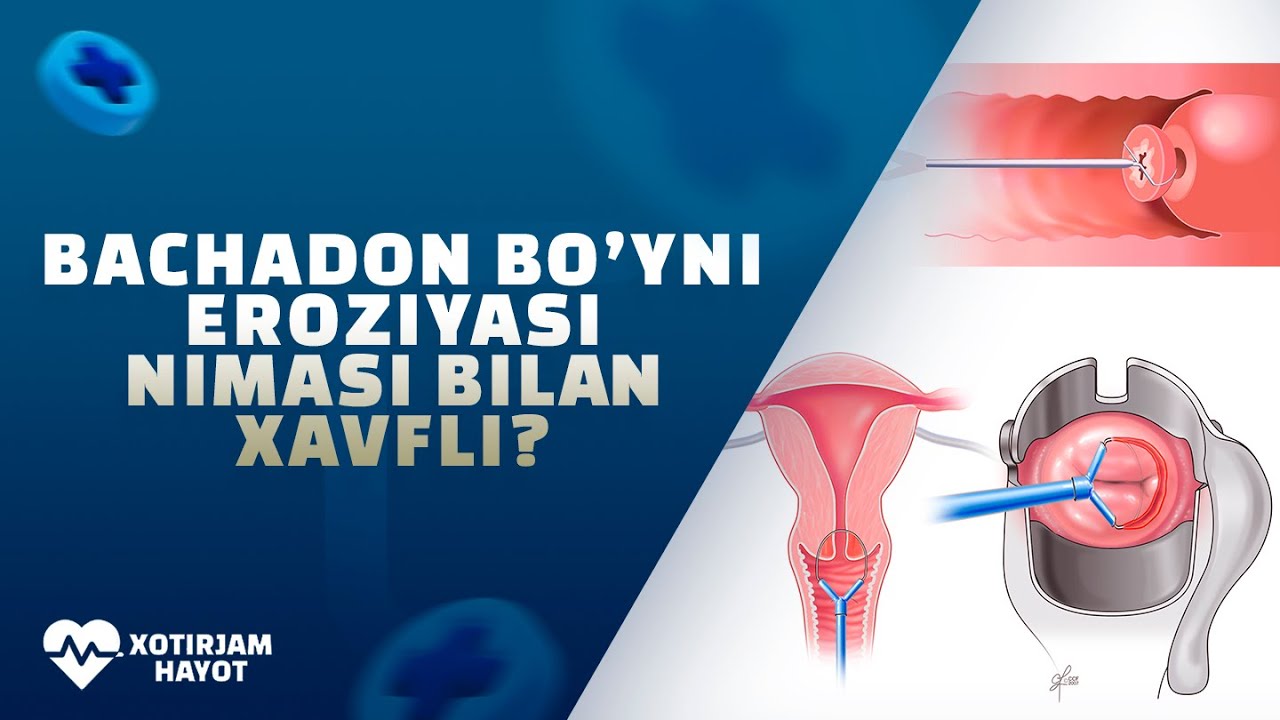 BACHADON BO'YNI EROZIYASI NIMA? SARATON XAVFI MAVJUDMI??