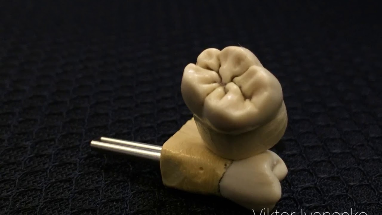 Waxing.Dental life. Live wax up.WAX-UP