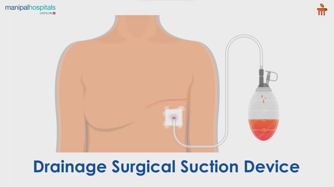 What is a Drainage Surgical Suction Device | Manipal Hospitals Bengaluru