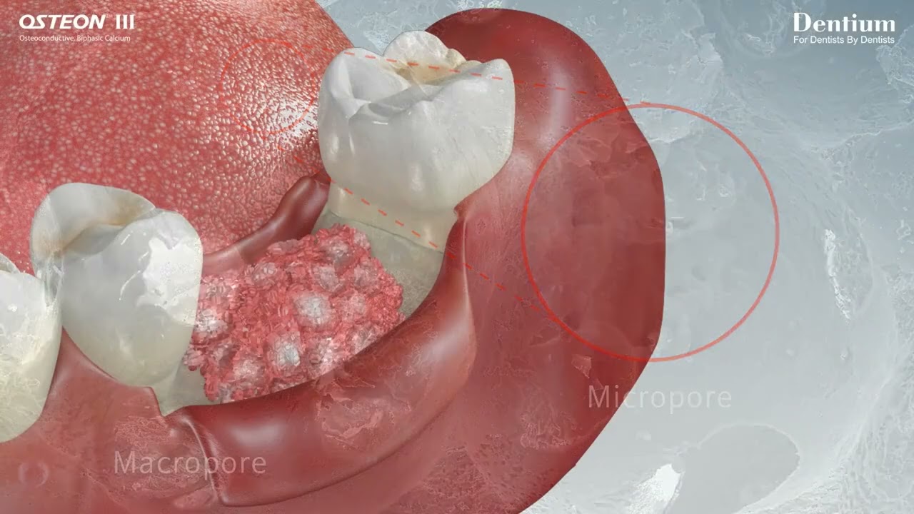 Dentium Osteon 3