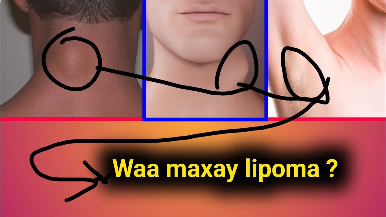 Waa maxay Lipoma ? maxaa sababo kuuskaan kasoo Baxa kilkisha , qoorta , dhuunta , iyo gacmaha.....
