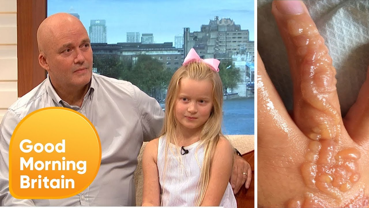 Black Henna Tattoo Scars Girl's Arm | Good Morning Britain