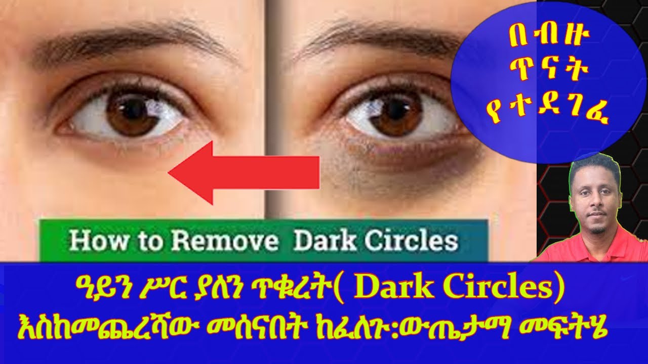 Ethiopia | ዓይን ሥር ያለን ጥቁረት( Dark Circles) እስከመጨረሻው መሰናበት ከፈለጉ : ውጤታማ መፍትሄ እነሆ