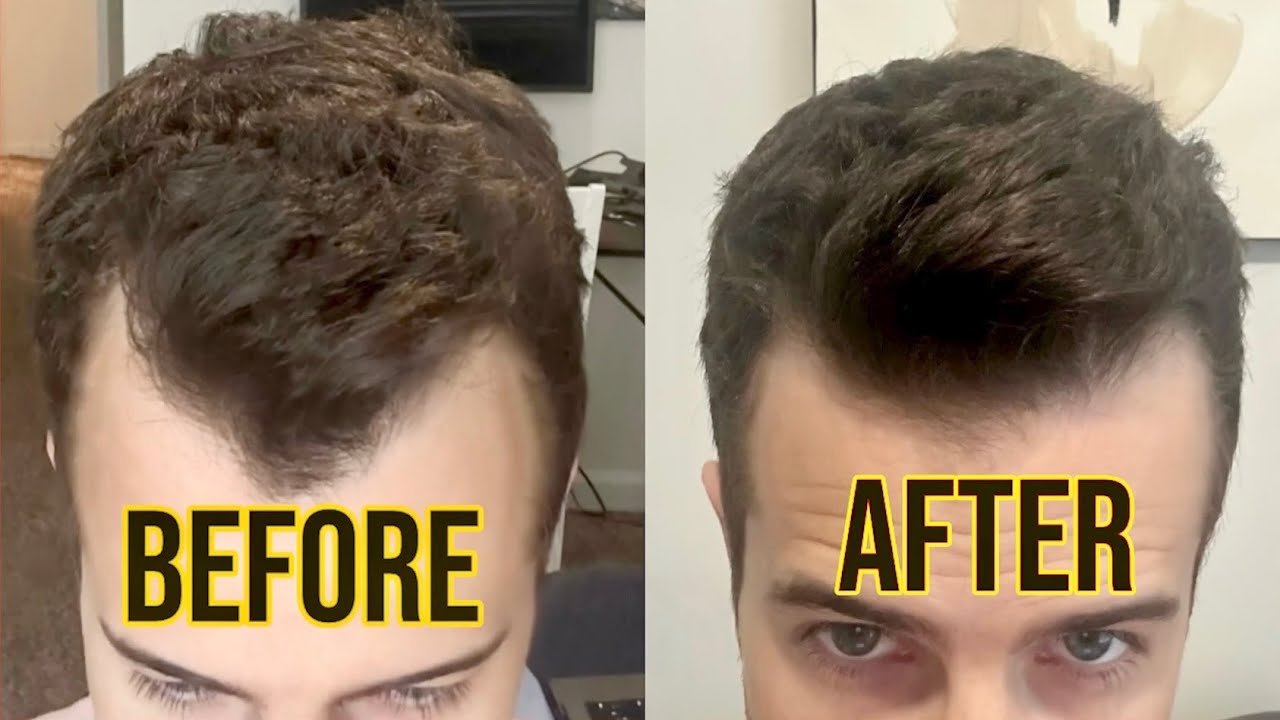 How I FIXED My Receding Hair Line (Men's Hair Loss Guide)